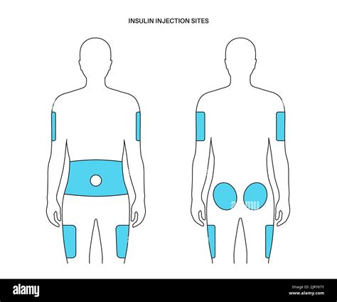 Insulin injection sites, illustration Stock Photo - Alamy