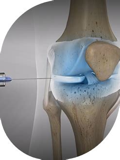 HYALGAN® Injection for Knee Pain | Nevada Pain Care