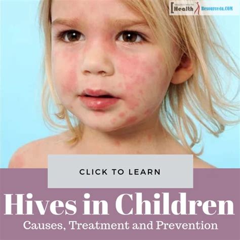 Hives In Children: Causes, Picture, Symptoms And Treatment