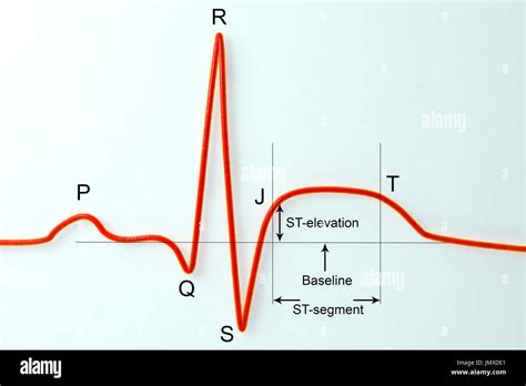 Electrocardiogram (ECG) during a myocardial infarction (heart attack ...