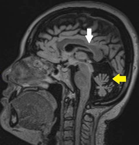 MRI Findings in a Patient with Known SCAR-16 Type STUB1 Associated ...