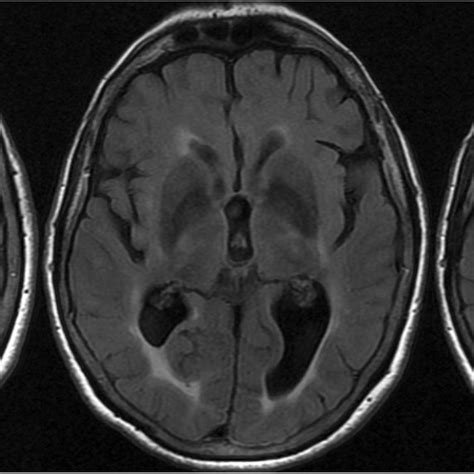 Axial T2-FLAIR brain MRI: left anterior choroid stroke sequelae and... | Download Scientific Diagram