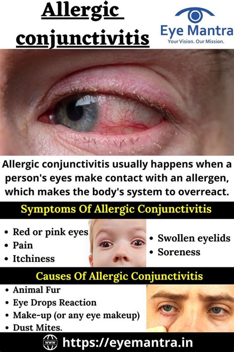 Allergic conjunctivitis symptoms types causes and treatment – Artofit