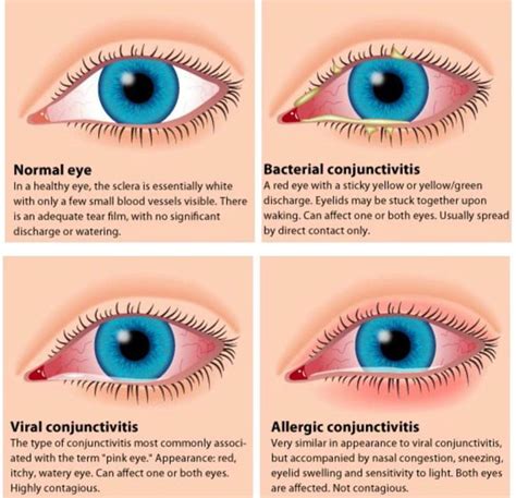 Causes of red eye and characteristics - MEDizzy