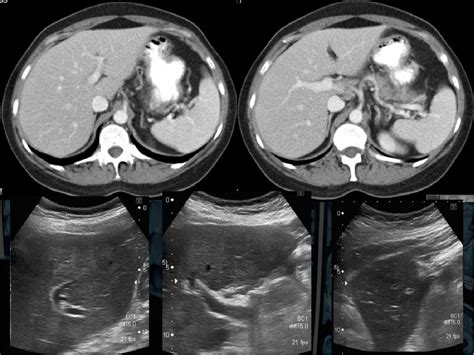 Ultrasound periportal cuffing: differential diagnosis | Semantic Scholar