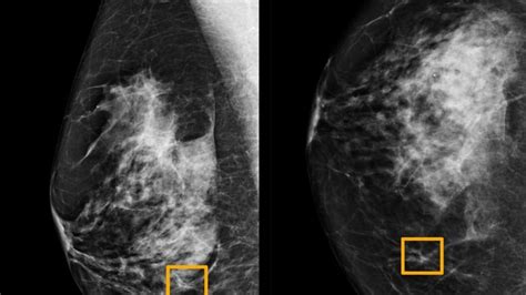 AI detects breast cancer as accurately as expert radiologists, study finds | CBC News