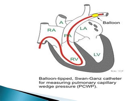 Pulmonary wedge pressure; Pulmonary Artery Wedge Pressure; Pulmonary ...