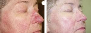 Laser Vein Removal – Spider Veins - DermaCare Cosmetic and Laser Clinic, Melbourne