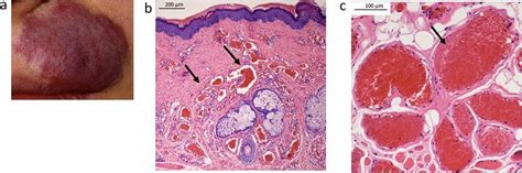 Images of a facial capillary malformation in a patient carrying the ...