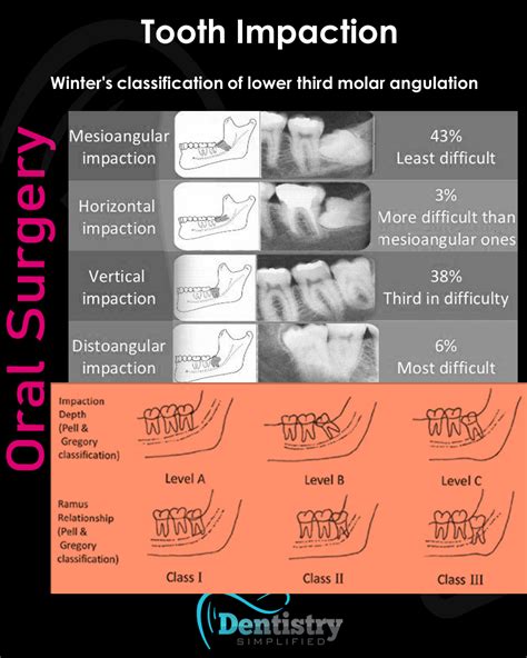 Winter's and Pell & Gregory's classifications of third molar impaction #Dentistrty #Dental ...