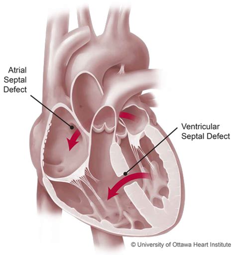 Adult Congenital Heart Defects - Ottawa Heart Institute