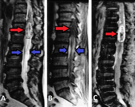 Cureus | Spinal Schwannoma with Intradural Intramedullary Hemorrhage