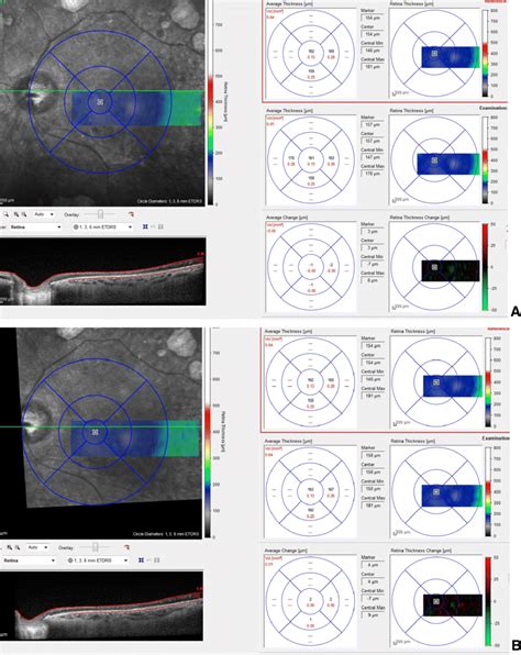 RNFL scan of patient 1 before (a) and after (b) treatment. The... | Download Scientific Diagram