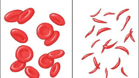 Gene therapy for sickle cell :: Understanding Animal Research