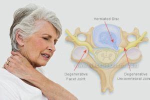 Cervical Spondylosis - Symptoms & Home Treatment Options