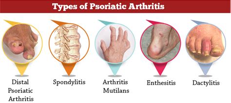 Journal of Clinical and Medical Research on Twitter: "Psoriatic arthritis is a form of arthritis ...