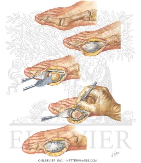 Silver Operation for Bunion