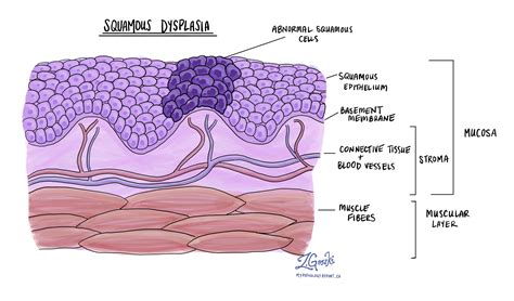 Squamous dysplasia of the oral cavity | MyPathologyReport.ca