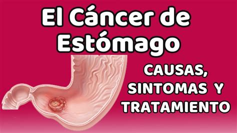 EL CÁNCER DE ESTÓMAGO, Causas, signos y síntomas, diagnóstico y tratamiento - YouTube