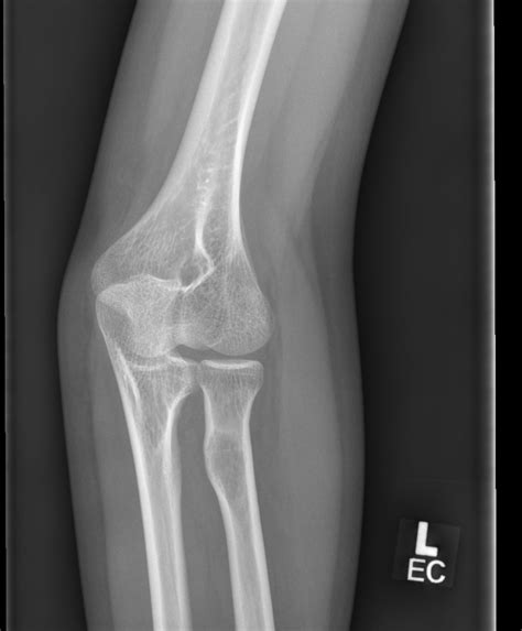 Radial Tuberosity