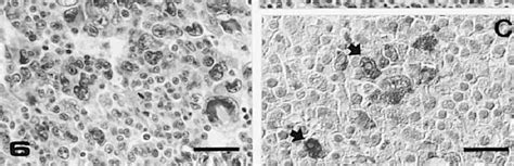 (A) Pituitary adenoma with monomorphic polygonal cell population in ...