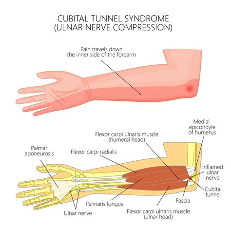 Nerve Entrapment, Injury and Neuropathy; Ulnar Nerve