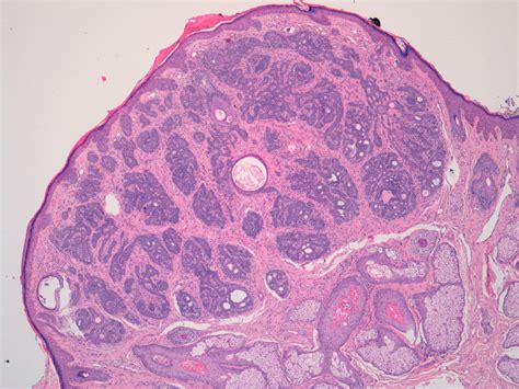 Trichoblastoma Histology