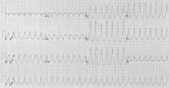 Myocardial infarction complications - Wikipedia