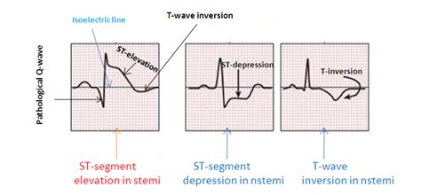 Online Medical Help: NSTEMI vs STEMI