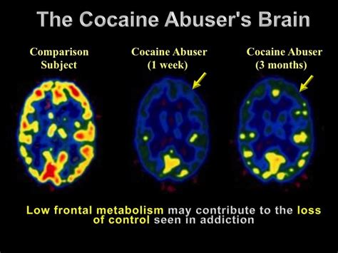 A look at How cocaine use affect the brain after addiction - Naija News Olofofo