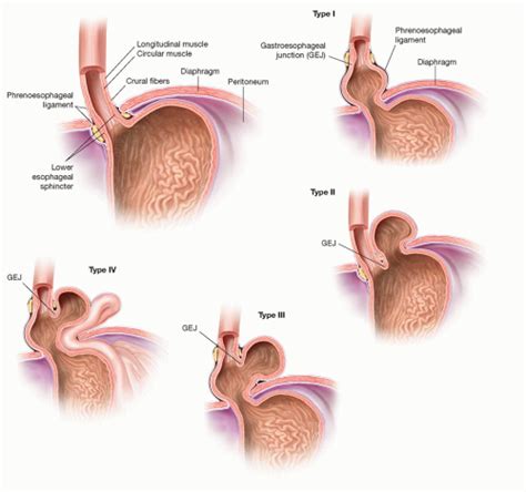 Types Of Hernias The Hernia Clinic