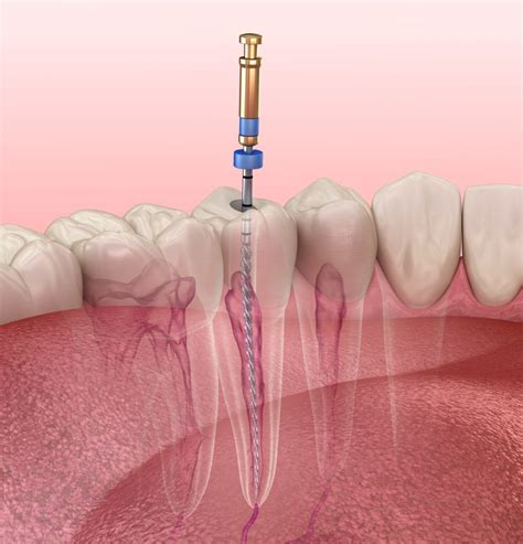 Step-By-Step: The Root Canal Procedure Explained | Dr. Alex Midtown NYC ...