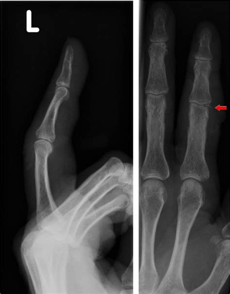 Avulsion Fracture Finger