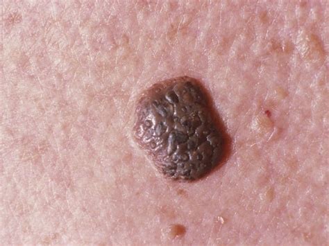 Seborrheic Keratoses: Everything You Need to Know | Brown spots on skin ...