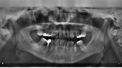 Reamer Family Dentistry Blog | Why Do We Take Dental X-rays?