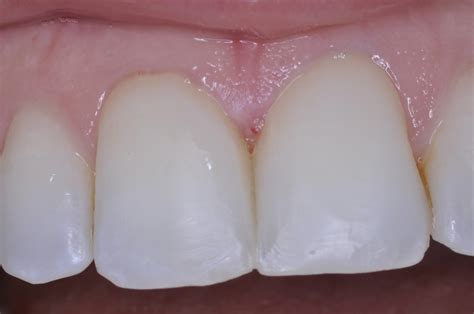 Ask Dr. Spindel: What can I do about 'black holes' between my teeth?