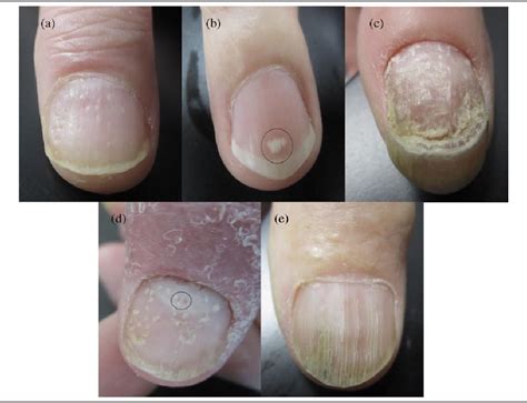 Psoriatic Nail Changes Are Associated With Clinical Outcomes in ...