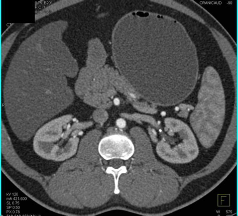 Normal CT Urogram - Kidney Case Studies - CTisus CT Scanning