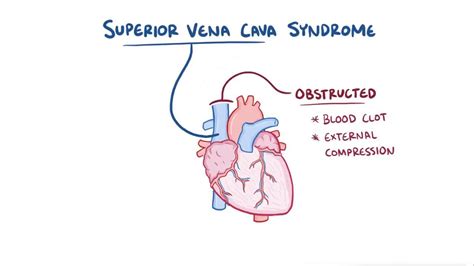 Superior vena cava syndrome: Video & Anatomy | Osmosis