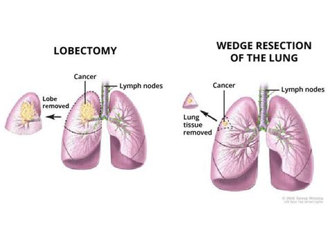 Lung-Sparing Surgery Effective for Early-Stage Lung Cancer - NCI