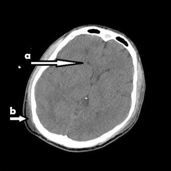 The initial CT scan showed right-brain swelling and narrow ventricles... | Download Scientific ...