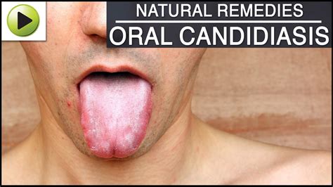 Oral Candidiasis - Natural Ayurvedic Home Remedies - YouTube