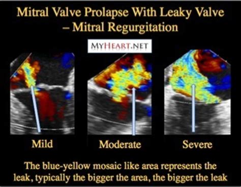 Leaky Heart Valve – When The Mitral Valve Fails