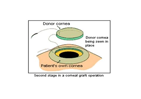 Penetrating Keratoplasty in Ahmedabad, Gujarat | Cornea Clinic