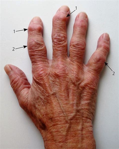 Degenerative Joint Disease - Causes & Treatment