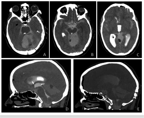 Postoperative CT Cisternogram Images Axial (A-C) and sagittal (D-E) CT... | Download Scientific ...