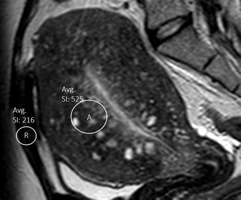 Objective measures of adenomyosis on MRI and their diagnostic accuracy ...