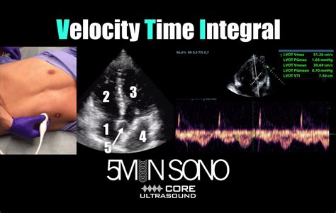 Volume Responsiveness LVOT VTI – Core Ultrasound