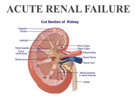 Acute Renal Failure Causes and Symptoms