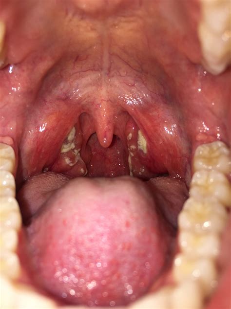 Infectious Mononucleosis: Pharyngitis and Morbilliform Rash - JETem